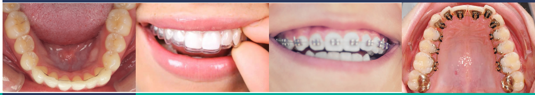 最左侧为C⁵ 隐藏式正畸系统  ，其余为透明矫治器、金属牙套与舌侧正畸