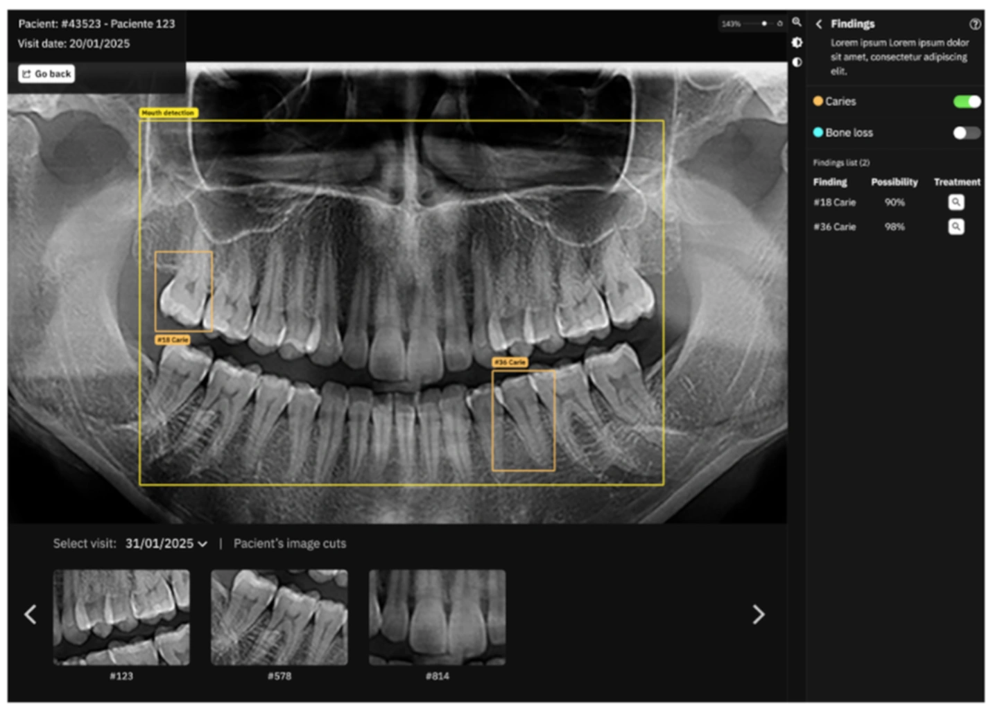 图源：AI-powered precision in dental radiographic analysis using tailored CNNs for tooth numbering and cavity detection