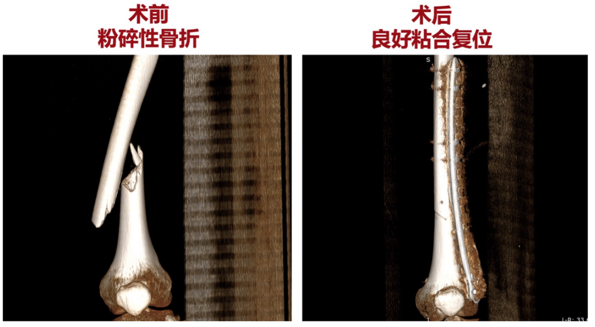 Treatment of comminuted femoral fracture with bone cement-assisted plate and screw fixation