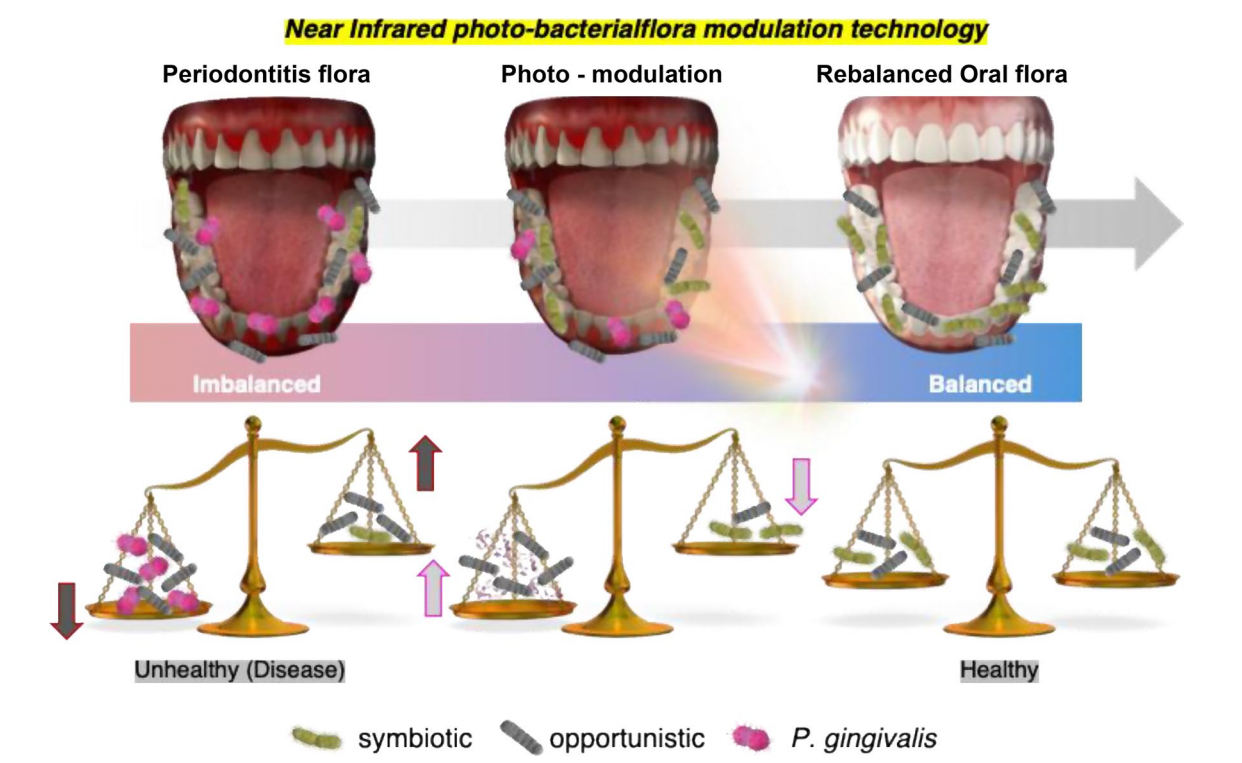 Image source: Near infrared photo-bacterial flora modulation technology realized controlling periodontitis: modulation of disease-associated dysbiosis in oral microbiota using near infrared photo-antibacterial targeting therapy (NIR-PAT2)